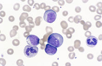 N0028727 Chronic myeloid leukaemia
Credit: Junia Melo. Wellcome Images
images@wellcome.ac.uk
http://images.wellcome.ac.uk
Smear of peripheral blood from a patient with chronic myeloid leukaemia (CML). The pink and purple cells are the white blood cells and the smaller, greyer cells are the red blood cells. CML is a cancer of the granulocytes and is common in people who have been exposed to radiation.
Photomicrograph
1985 Published:  - 

Copyrighted work available under Creative Commons by-nc-nd 2.0 UK, see http://images.wellcome.ac.uk/indexplus/page/Prices.html